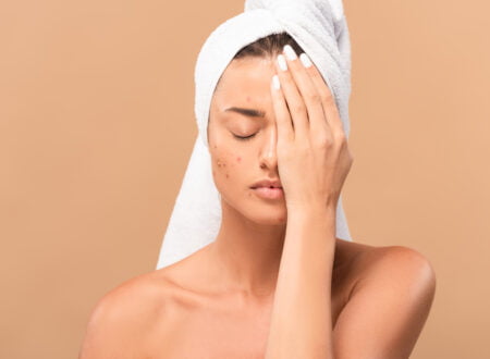 Clearing The Confusion Understanding Acne And Effective Treatment Options
